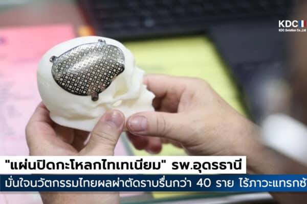 Titanium Cranial Implant